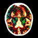 Rare cases of Alzheimer’s disease infection discovered in patients who discontinue treatment